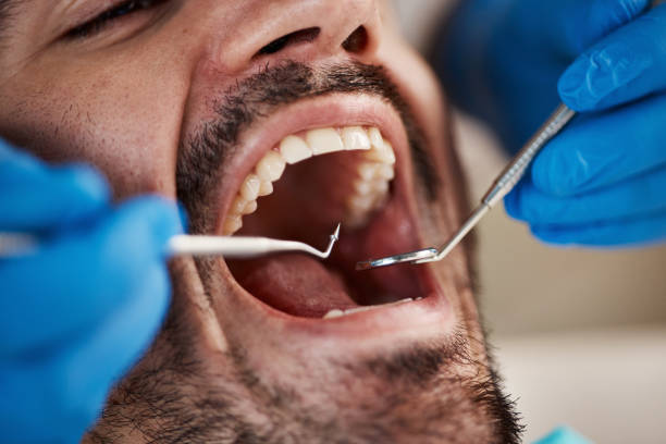 Best Lost Filling or Crown Replacement in Immokalee, FL